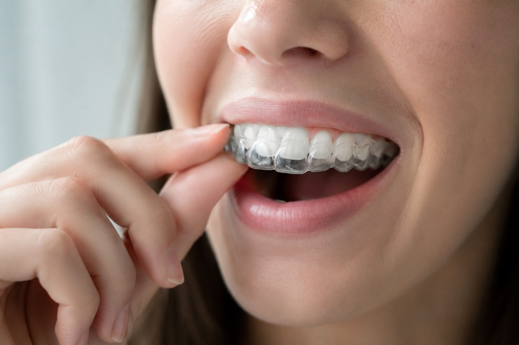 Patient fitting a clear Invisalign aligner over their upper teeth