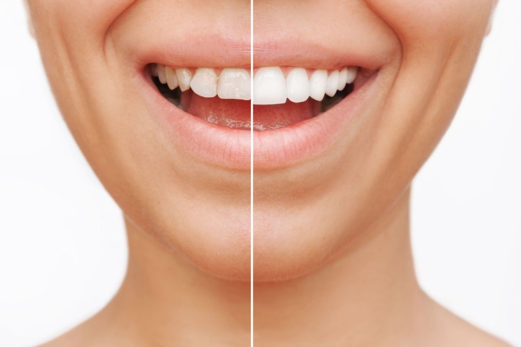 Before and after smile showing composite bonding results