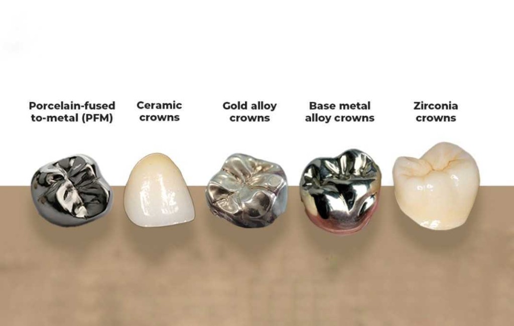 Comparison of porcelain-fused-to-metal, ceramic, gold, base metal, and zirconia dental crowns