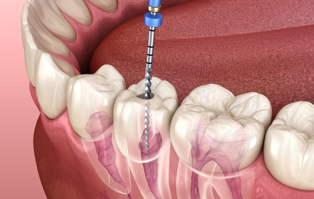 3D illustration of a root canal file treating the pulp inside a molar