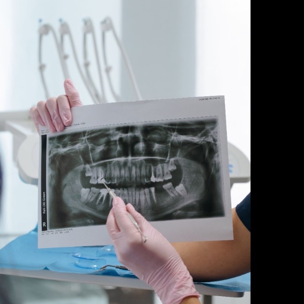 Dentist pointing to a panoramic dental X-ray during wisdom teeth assessment